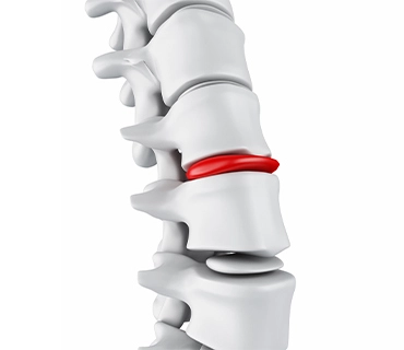 dolor disco lumbar