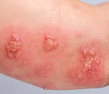 Dolor por neuralgia postherpetica