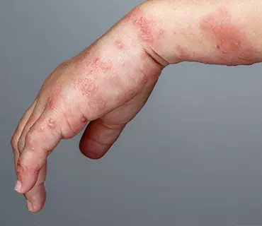 Dolor por neuralgia postherpetica