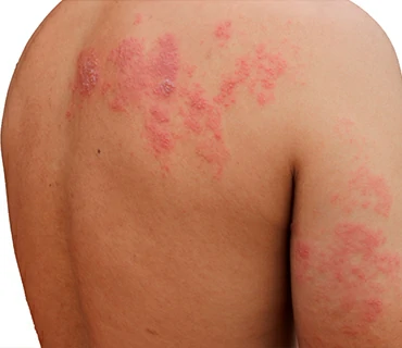 neuralgia postherpetica